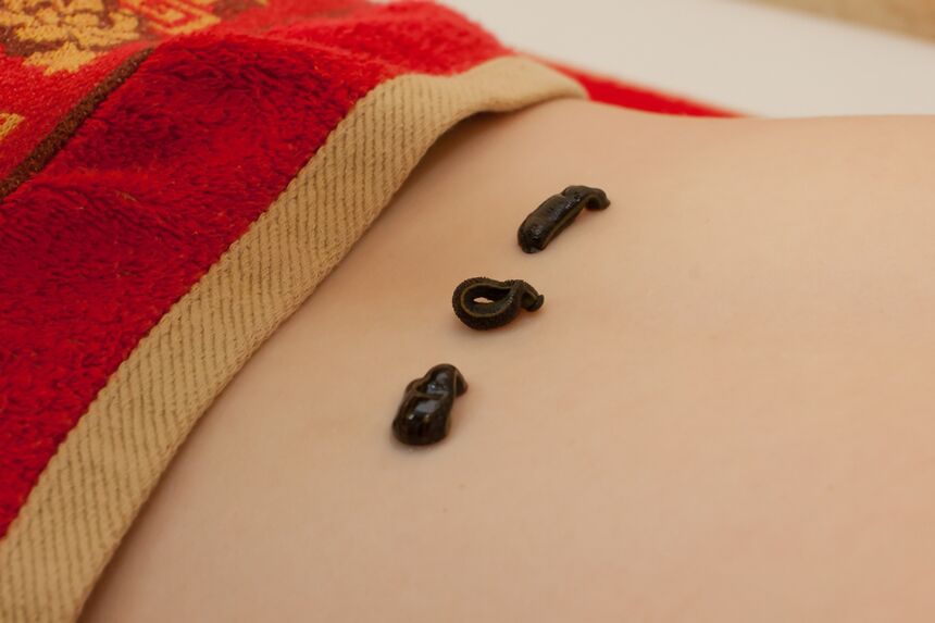 sangsues dans le bas du dos avec ostéochondrose